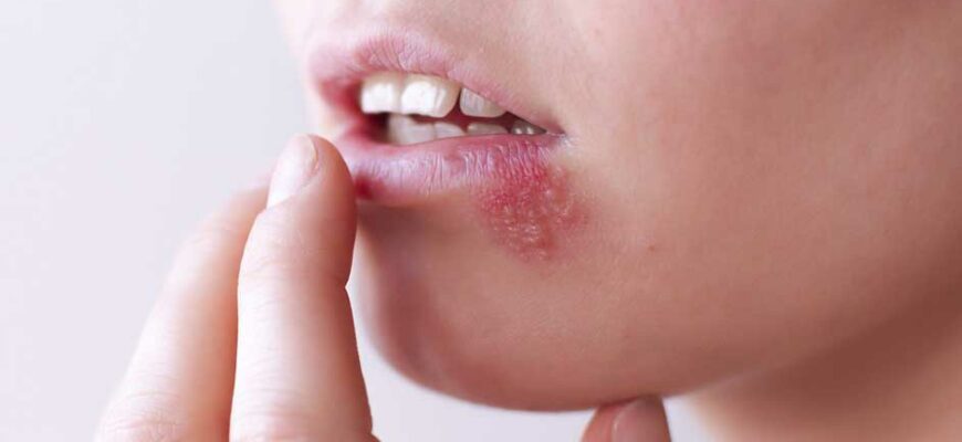 Простуда на губах: как избавиться быстро в домашних условиях
