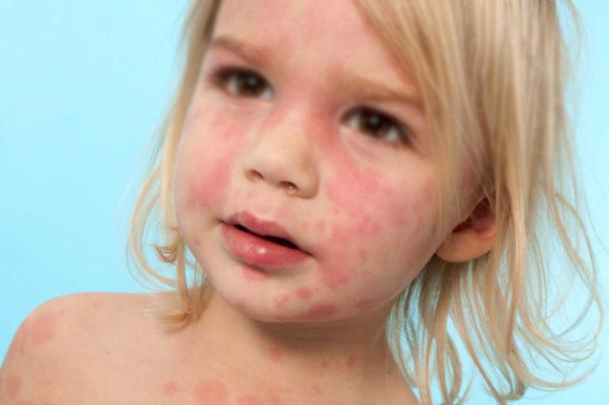 Если у ребенка пищевая аллергия что делать