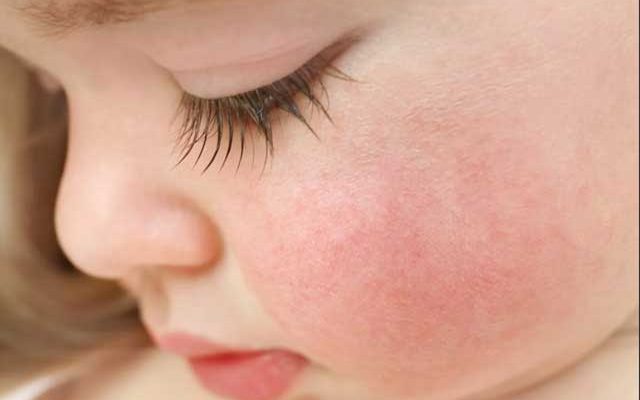 Пищевая аллергия у ребёнка что делать