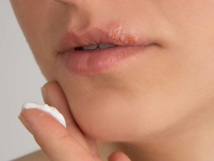 Как избавиться от вируса герпеса на губах 
