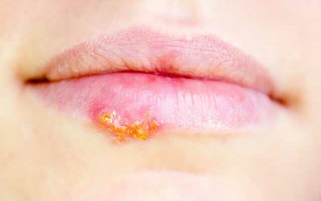 Как избавиться от вируса герпеса на губах