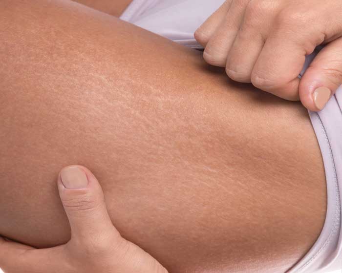 Лечение растяжек на коже в домашних условиях 