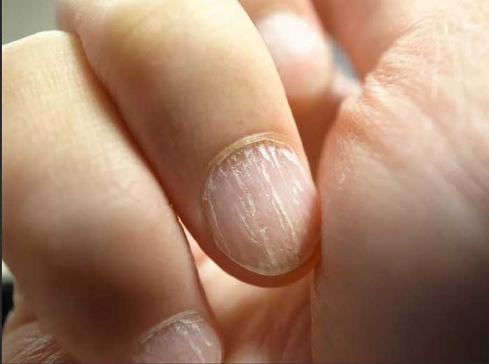 Как ухаживать за ломкими ногтями