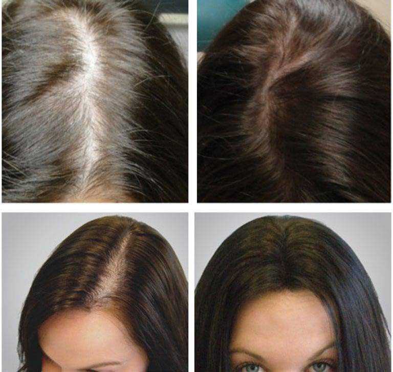 Восстановление волос с помощью мезотерапии