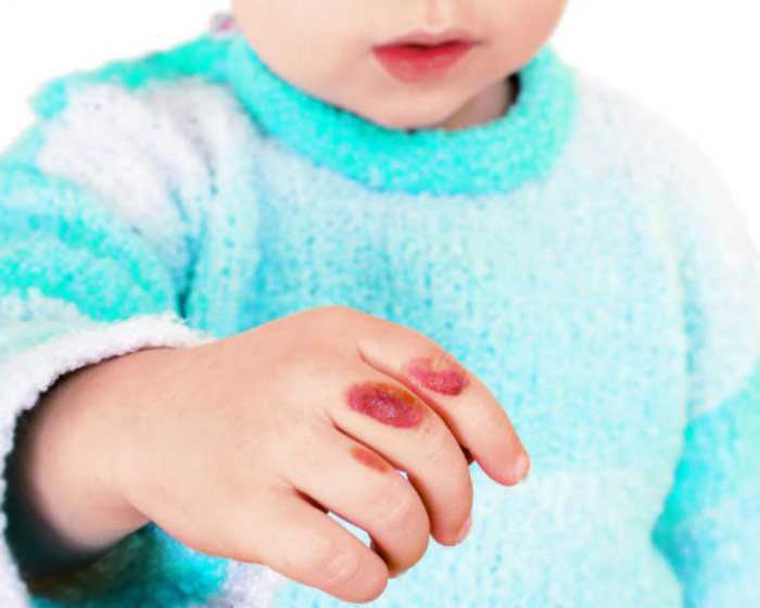 Основы оказания первой помощи ребёнку при бытовых травмах